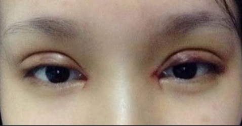 全切雙眼皮一般多久才能消腫？全切雙眼皮術(shù)后如何護理？