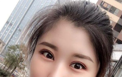 全切雙眼皮多長(zhǎng)時(shí)間恢復(fù)自然？