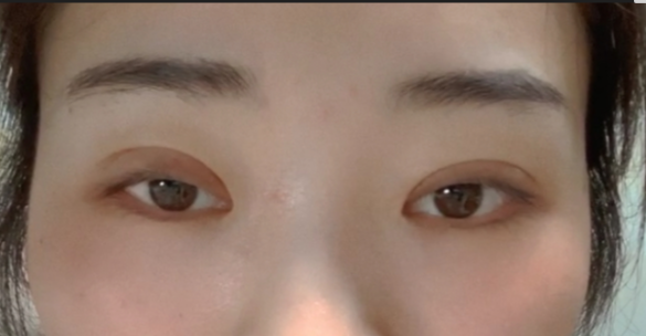 什么是全切雙眼皮？全切雙眼皮的恢復時間？