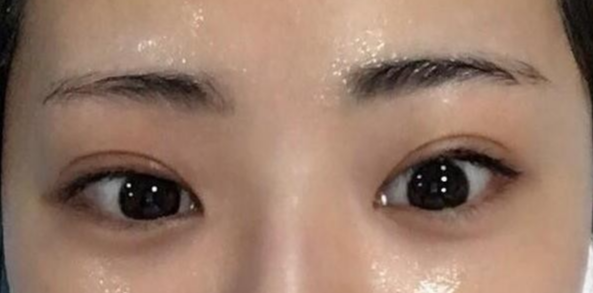 雙眼皮全切的風險有哪些？