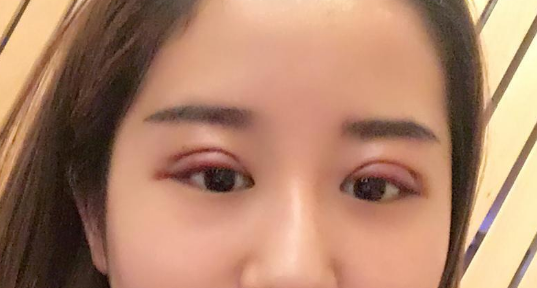 全切雙眼皮好不好？全切雙眼皮多長(zhǎng)時(shí)間恢復(fù)自然？