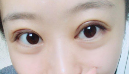 全切雙眼皮手術(shù)時間？全切雙眼皮術(shù)后會反彈嗎？