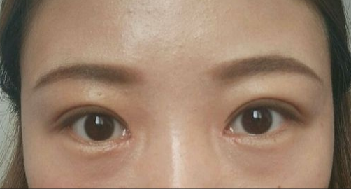 全切雙眼皮能保持多久？全切雙眼皮的危害有哪些？