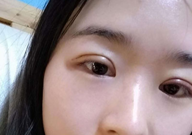 全切雙眼皮大概多少錢？全切雙眼皮多久能恢復？