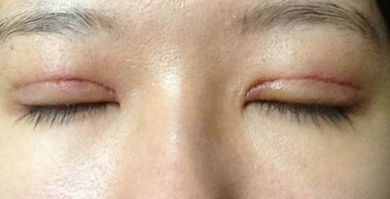 全切雙眼皮到底疼不疼？