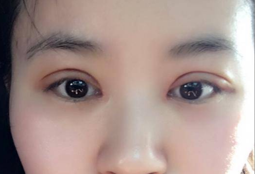 做全切雙眼皮多少錢？