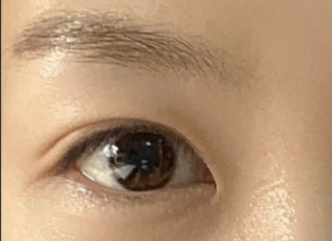 全切雙眼皮效果怎么樣？全切雙眼皮多久自然？