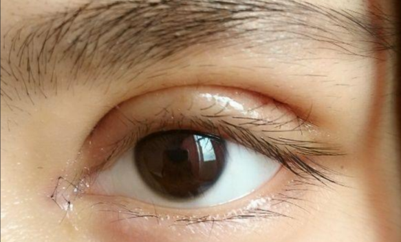 全切雙眼皮會留疤嗎？全切雙眼皮的優(yōu)缺點？