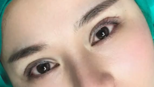 全切雙眼皮會消失嗎？