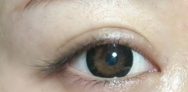 雙眼皮做埋線好還是全切好？