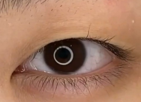 全切雙眼皮疤痕多久能消失？全切雙眼皮幾天可以洗臉？