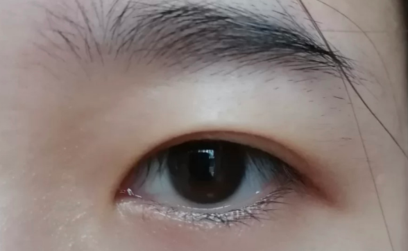雙眼皮全切好還是韓式三點微創(chuàng)好？