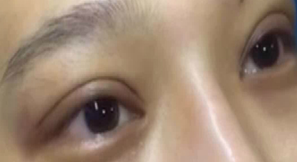 埋線雙眼皮大概能保持幾年？