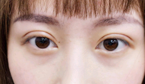 埋線雙眼皮需要拆線嗎？