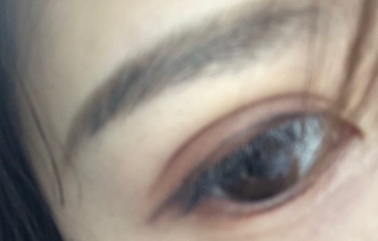 埋線雙眼皮疼嗎？埋線雙眼皮手術(shù)優(yōu)勢有哪些？