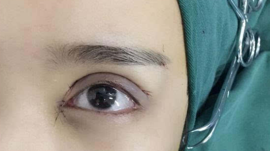 埋線雙眼皮會(huì)不會(huì)脫線？