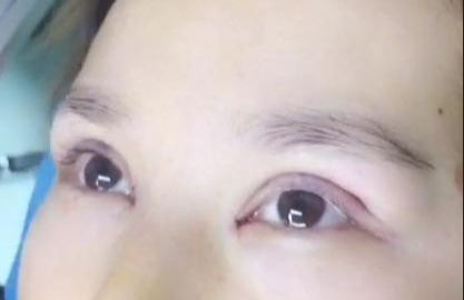 埋線雙眼皮有哪些注意事項(xiàng)？