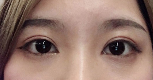 埋線雙眼皮幾天可以碰水？