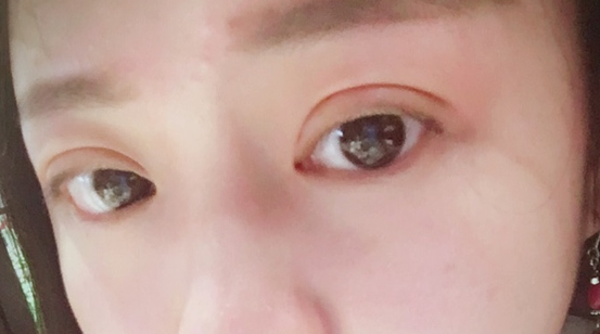 埋線雙眼皮可以保持幾年？埋線雙眼皮的危害有哪些？