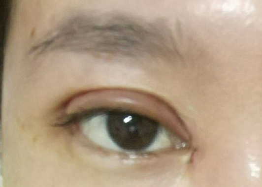 埋線雙眼皮可以維持幾年？