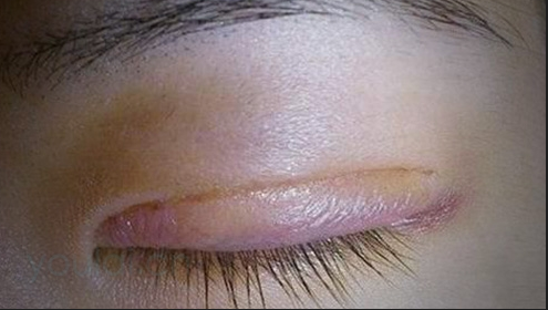 埋線雙眼皮一般會(huì)腫幾天？雙眼皮埋線好還是切開好？