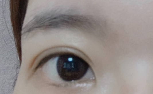 雙眼皮埋線大概多久恢復(fù)？