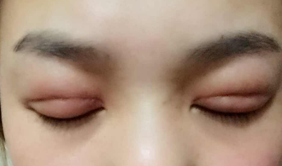 埋線雙眼皮幾天能消腫？