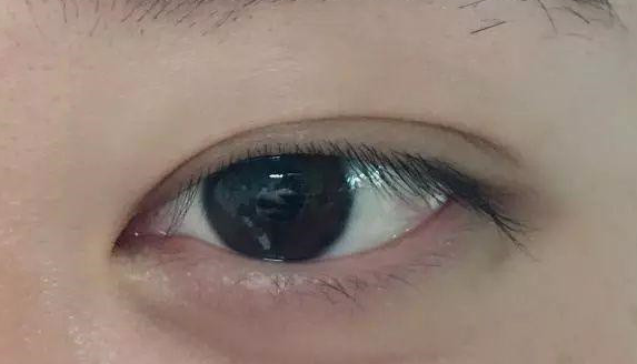 埋線雙眼皮有沒有危害？