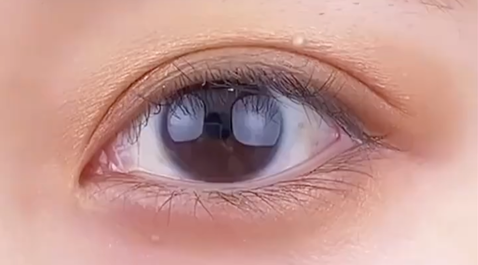 定點(diǎn)雙眼皮多少錢(qián)？雙眼皮定點(diǎn)好嗎？