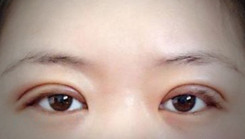定點(diǎn)雙眼皮幾天能恢復(fù)好？定點(diǎn)做雙眼皮多少錢(qián)？