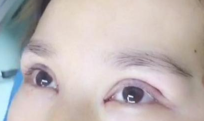 定點雙眼皮手術(shù)效果自然嗎？