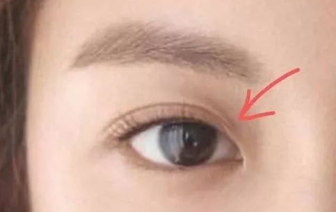 定點雙眼皮一般多少錢？