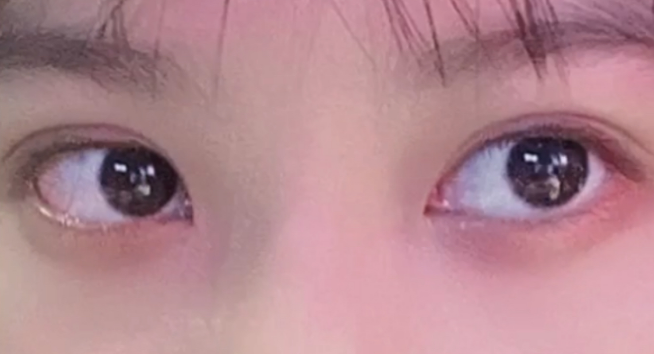 雙眼皮定點能維持多久？