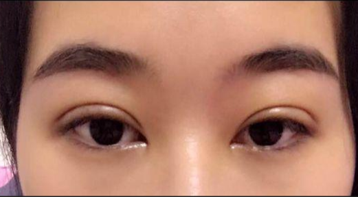 單眼皮割雙眼皮風(fēng)險大嗎？