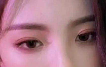 割雙眼皮會有疤痕嗎？割雙眼皮幾個月定型？