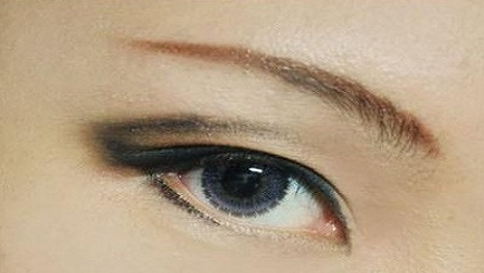 疤痕皮膚可以割雙眼皮嗎？40歲做埋線雙眼皮的效果好不好？