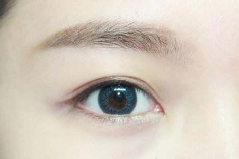 割雙眼皮幾個(gè)月定型？