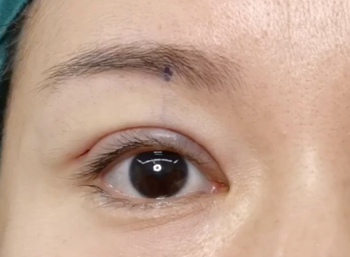 割雙眼皮后有危害嗎？