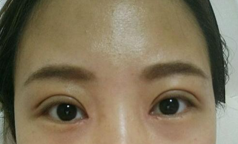 定點(diǎn)雙眼皮會腫嗎？定點(diǎn)雙眼皮會有疤痕嗎？