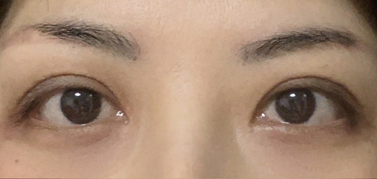定點(diǎn)雙眼皮會(huì)腫嗎？