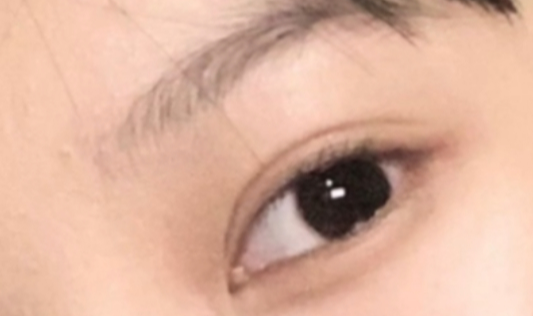 割雙眼皮恢復(fù)需要多久？