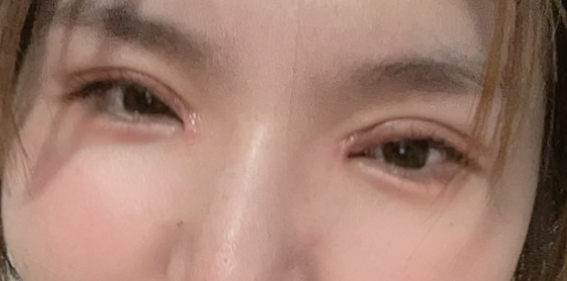 割雙眼皮后要冰敷多久？