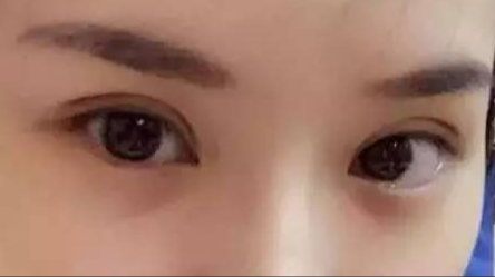 做雙眼皮對身體有沒有危害？
