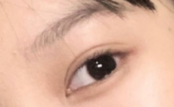 做雙眼皮效果能保持多久？做雙眼皮要冰敷多久？
