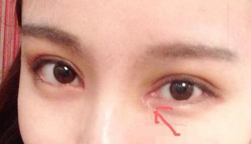 單眼皮開內眼角會留疤嗎？