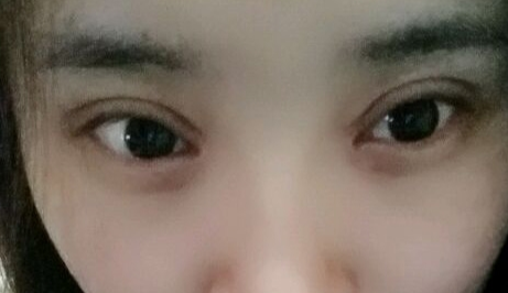 開(kāi)眼角疼嗎？