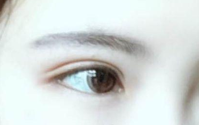 開眼角的恢復(fù)期多長？開眼角的后遺癥都有什么？
