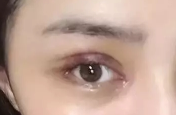 韓式開眼角失敗了怎么辦？