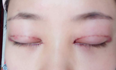 韓式開眼角手術(shù)有哪些優(yōu)勢？開眼角手術(shù)有哪些優(yōu)勢？