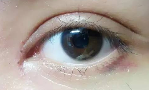 韓式開眼角好嗎？韓式開眼角術后怎么護理？